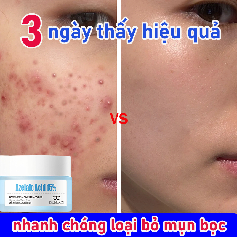 Kem Giảm Mụn Chuyên Sâu LYDIMOON 20g - Xóa Mụn Viêm, Mụn Mủ Cấp Tốc, Làm Mờ Thâm Sẹo Hiệu Quả
