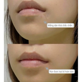 Miếng dán mụn DermSmile siêu mỏng 0.2mm – 96 miếng (10mm & 12mm)