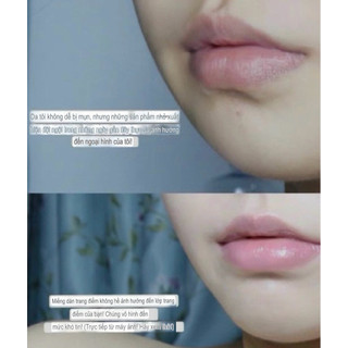 Miếng dán mụn DermSmile siêu mỏng 0.2mm – 96 miếng (10mm & 12mm)