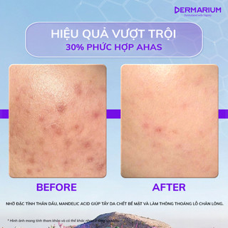 Serum peel da an toàn 30% AHAS Dermarium Bittersweet giúp tẩy tế bào da chết, hỗ trợ giảm mụn, sáng da 10ml