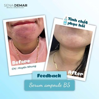 Serum B5 SENA DEMAR B5 MICRONEEDLE AMPOULE 50ml/100ml serum b5 senademar PH