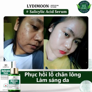 Tinh Chất Se Khít Lỗ Chân Lông Tinh Chất Mụn Chính Xác Axit Salicylic Chống Mụn Vết Thâm 30ML