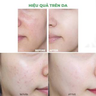 Sữa rửa mặt giảm mụn kiềm dầu Der ma Anti acne deep cleansing gel /CETAPHIL - Lamii Beauty
