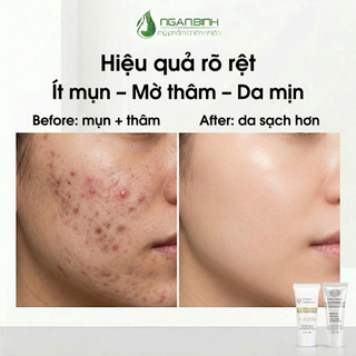 Kem mụn thâm Derma anti acnes (chính hãng)