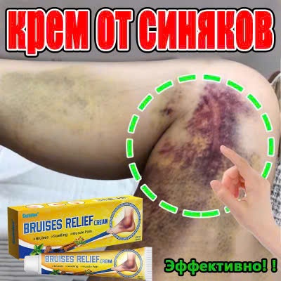 Kem Làm Mờ Vết Bầm Bruises Relief Cream Dưỡng Da Mềm Mại Giảm Cảm Giác Khó Chịu 30G