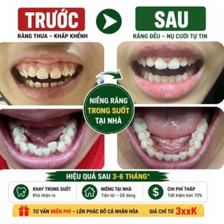 Khay niềng răng trong suốt True Smile (cần mẫu hàm răng )