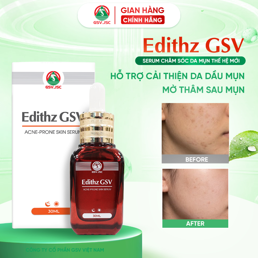 Edithz GSV Cải Thiện Làn Da Mụn, Giúp Dưỡng Ẩm Sâu, Giảm Thâm Sau Mụn