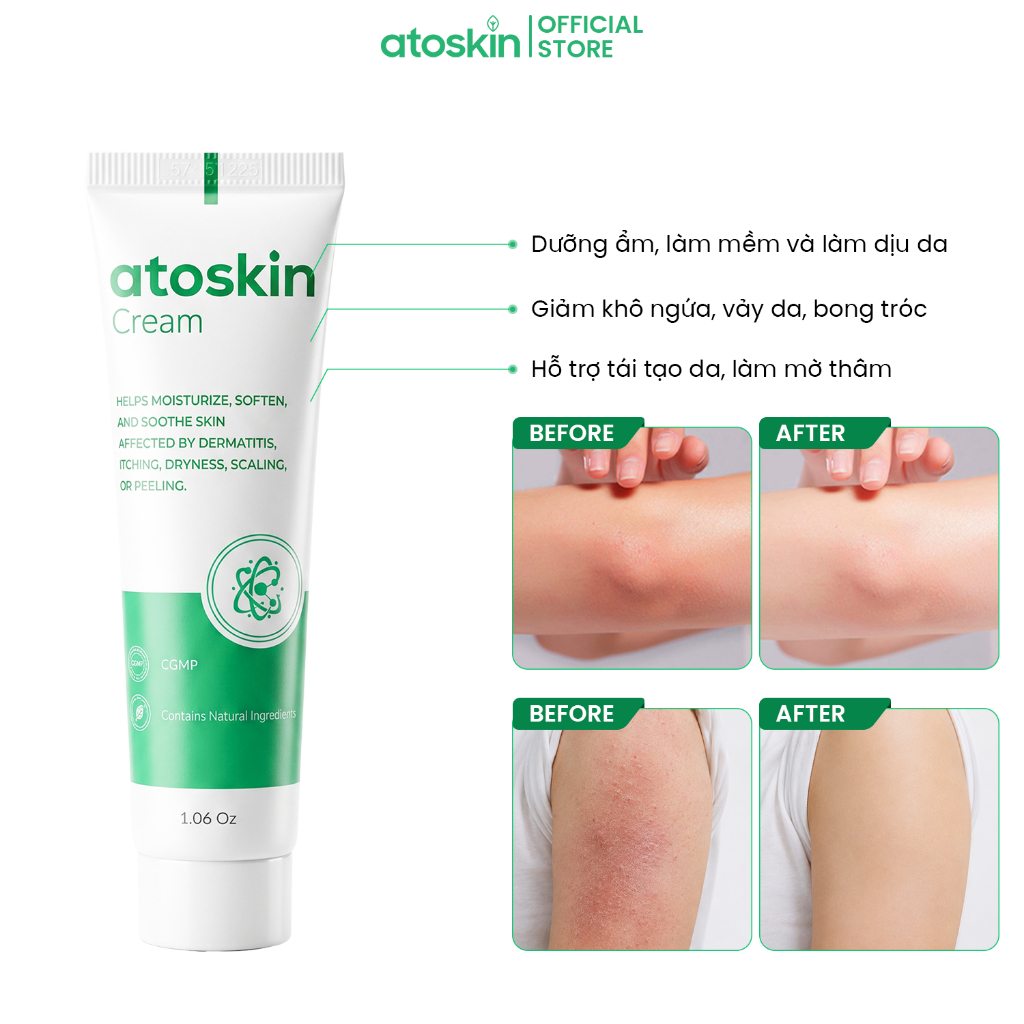 [QUÀ TẶNG KHÔNG BÁN] Kem Bôi Viêm Da Cơ Địa Atoskin Cream 30g - Hỗ Trợ Dưỡng Ẩm, Giảm Khô Ngứa, Khôn