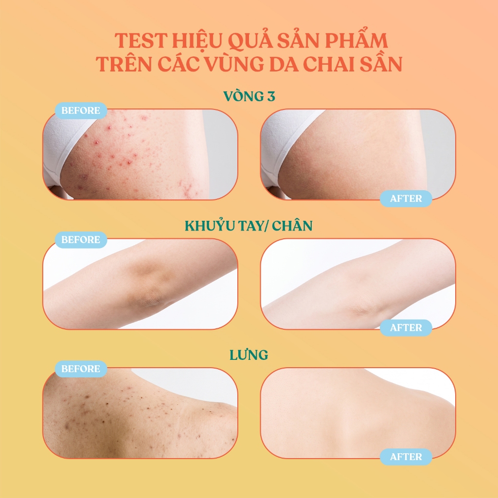 Tẩy tế bào chết Mông Bbutter Scrub giảm mụn, mờ thâm vòng 3 & body 300ml | BigBuy360 - bigbuy360.vn