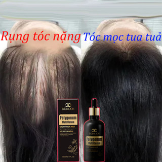  Kích thích mọc tóc Thuốc kích thích mọc tóc Tinh dầu dưỡng tóc 50ml chăm sóc giúp mọc tóc Ngăn Ngừa Tóc Gãy Rụng 