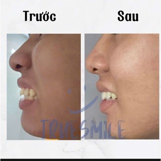 Khay niềng răng trong suốt True Smile (cần mẫu hàm răng )