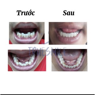 Khay niềng răng trong suốt True Smile (cần mẫu hàm răng )