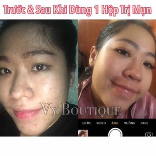 Kem Mụn Thảo Dược