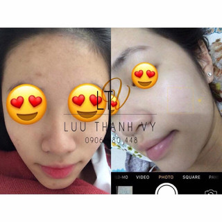 Kem Mụn Thảo Dược