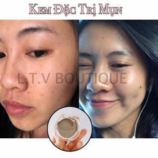 Kem Mụn Thảo Dược