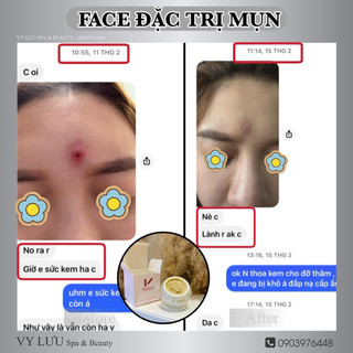 Kem Mụn Thảo Dược