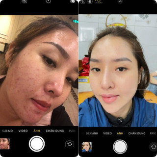 Kem Mụn Thảo Dược