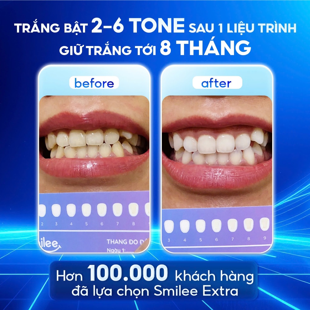[GIÁ 638K TẠI LIVE SHOP] Trắng răng Smilee Extra, bộ kit làm trắng răng từ 2-6 tone sau một liệu trình. Hàng chính hãng | BigBuy360 - bigbuy360.vn
