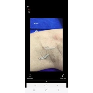 Peel thâm nách, mông, bẹn medicos blue peel