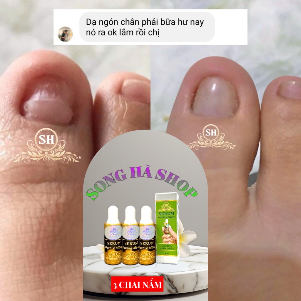 [Chính hãng SH] Combo 3 lọ Serum nấm móng, bọng móng, hư khoé, nước ăn tay chân, dưỡng cứng móng