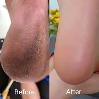 Combo 3 Cây Chà Gót Chân Cán Nhựa Loại Bỏ Da Chết, Dụng Cụ Chà Gót Giúp Da Mịn Màng Không Nứt Nẻ