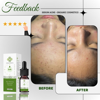 Serum Acne 24h ngừa mụn 5ml