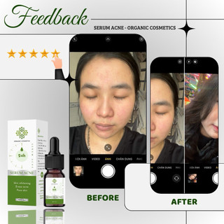 Serum Acne 24h ngừa mụn 5ml