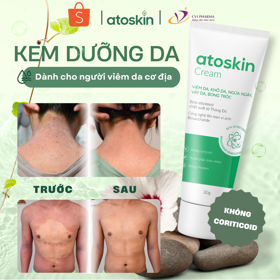 Kem Bôi Viêm Da Cơ Địa ATOSKIN 30G - Hỗ Trợ Làm Dịu Da Khi Bị Nấm, Chàm, Tổ Đỉa, Á Sừng, Mụn Nước