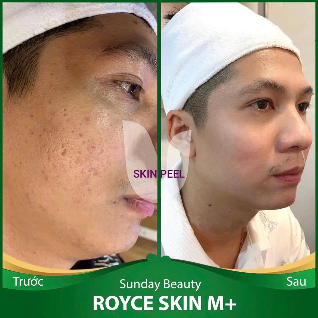 [Peel da] Peel da ROYCE SKIN M+ Peel da công nghệ tiên tiến mới A22 peel da