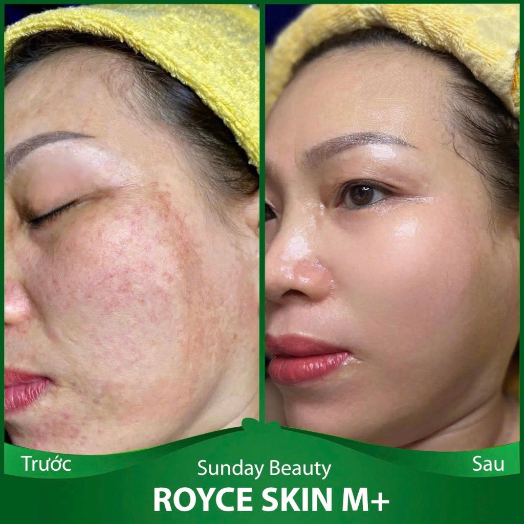 [Peel da] Peel da ROYCE SKIN M+ Peel da mang lại vẻ đẹp tiềm ẩn A22 peel da