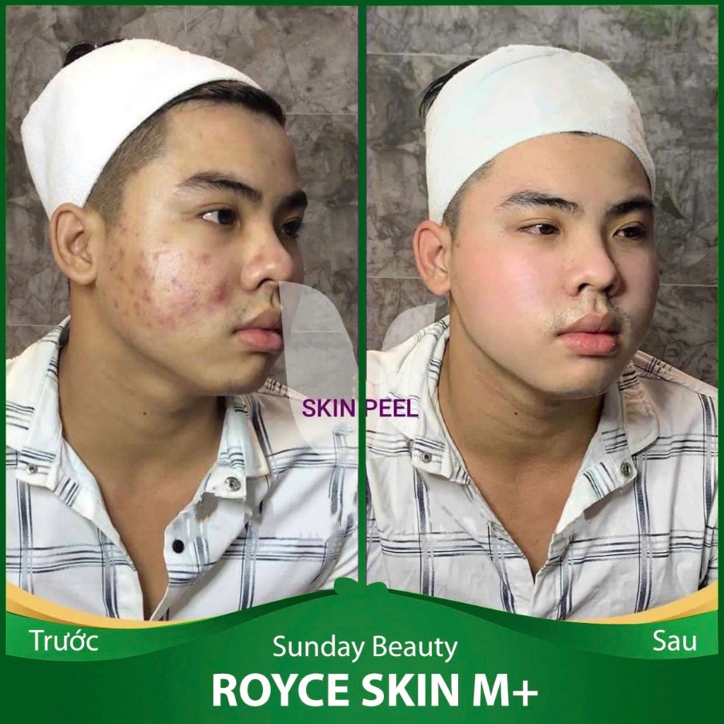 [Peel da] Peel da ROYCE SKIN M+ Peel da tái sinh diện mạo thời thanh xuân A22 peel da