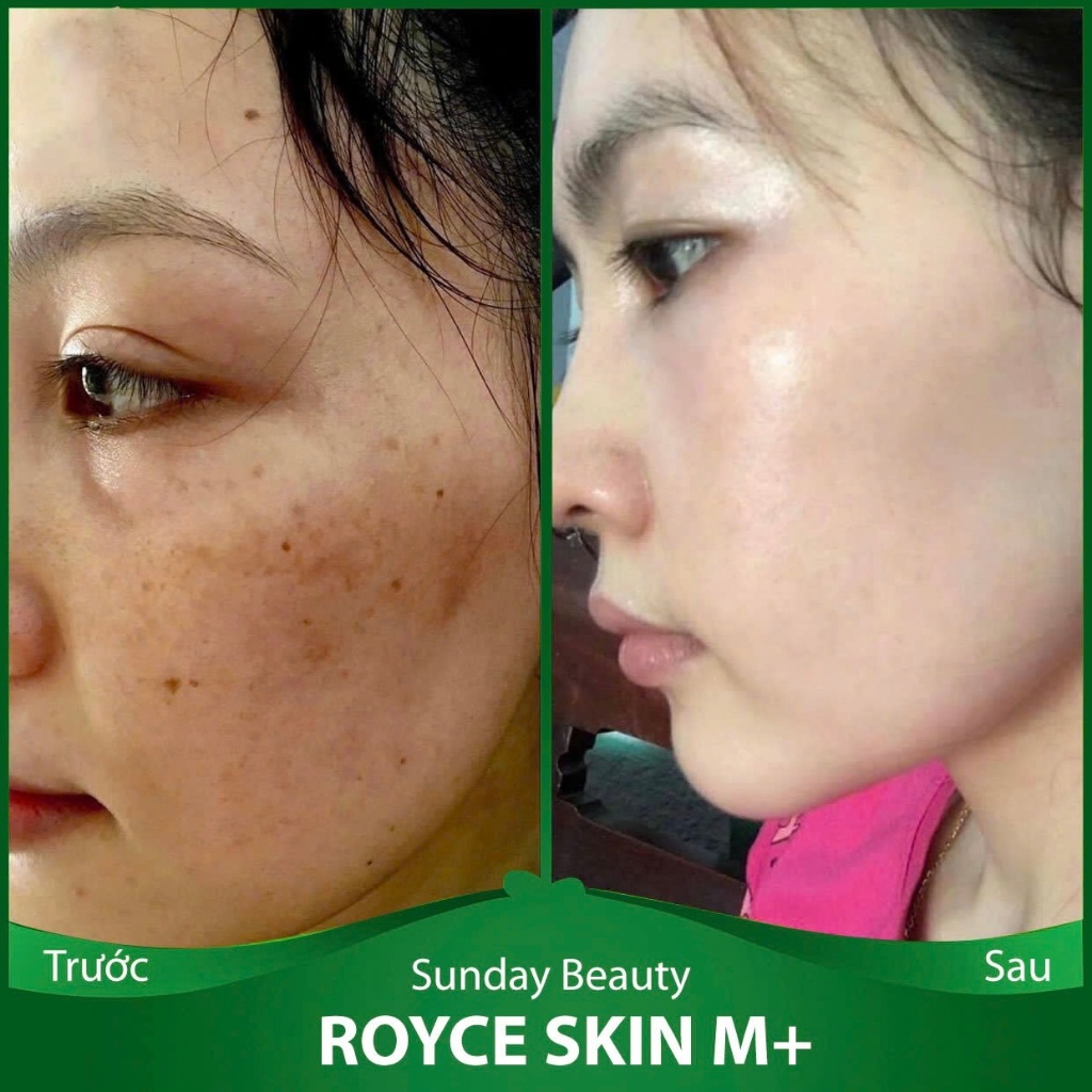 [Peel da] Peel da ROYCE SKIN M+ Peel da sinh học chuẩn minh tinh A22 peel da