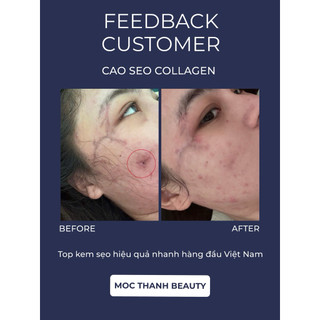 Cao Sẹo Collagen Chính Hãng Mộc Thanh Beauty ( Chuyên xoá sẹo lòi , lõm , sẹo thâm …)