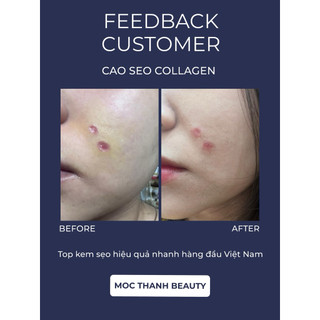 Cao Sẹo Collagen Chính Hãng Mộc Thanh Beauty ( Chuyên xoá sẹo lòi , lõm , sẹo thâm …)