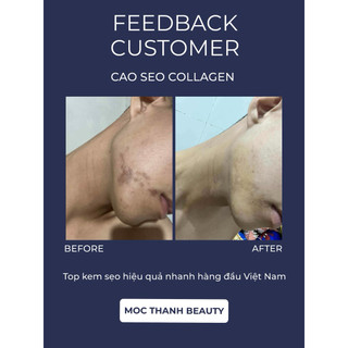 Cao Sẹo Collagen Chính Hãng Mộc Thanh Beauty ( Chuyên xoá sẹo lòi , lõm , sẹo thâm …)