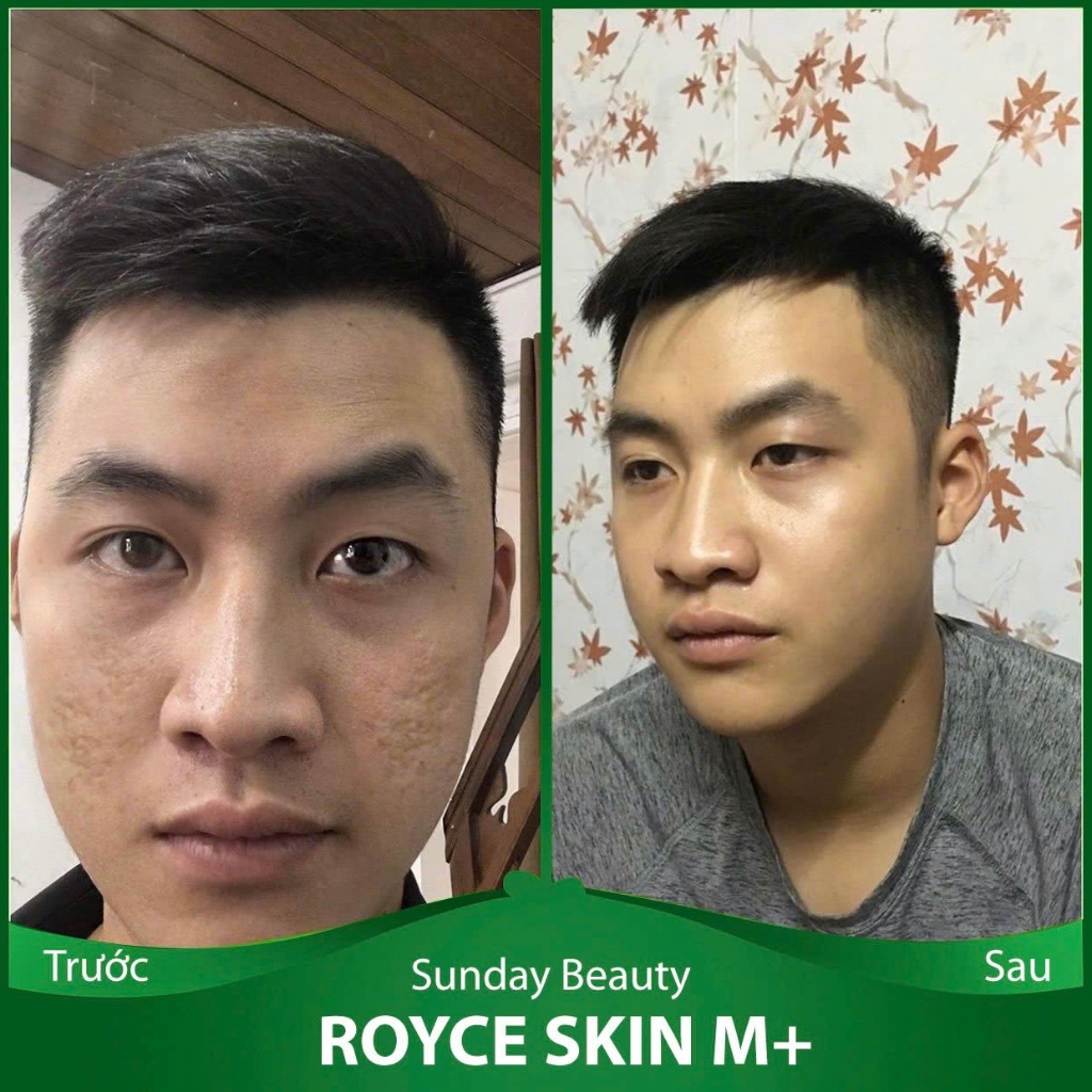 [Peel da] Peel da ROYCE SKIN M+ Da bong mảng to peel da làm đẹp theo xu hướng A22 peel da