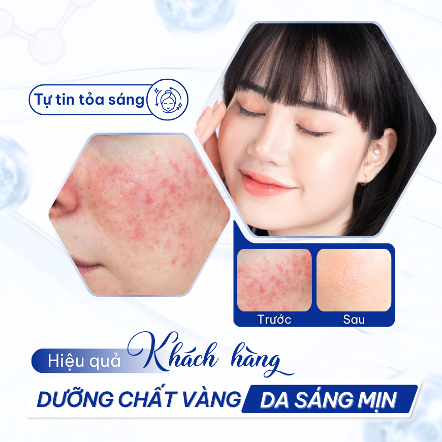 Serum Compliment Azelaic Acid Mờ Thâm Mụn, Làm Dịu Mẫn Đỏ & Kiềm Soát Dầu Cho Da Nhạy Cảm 27ml | BigBuy360 - bigbuy360.vn