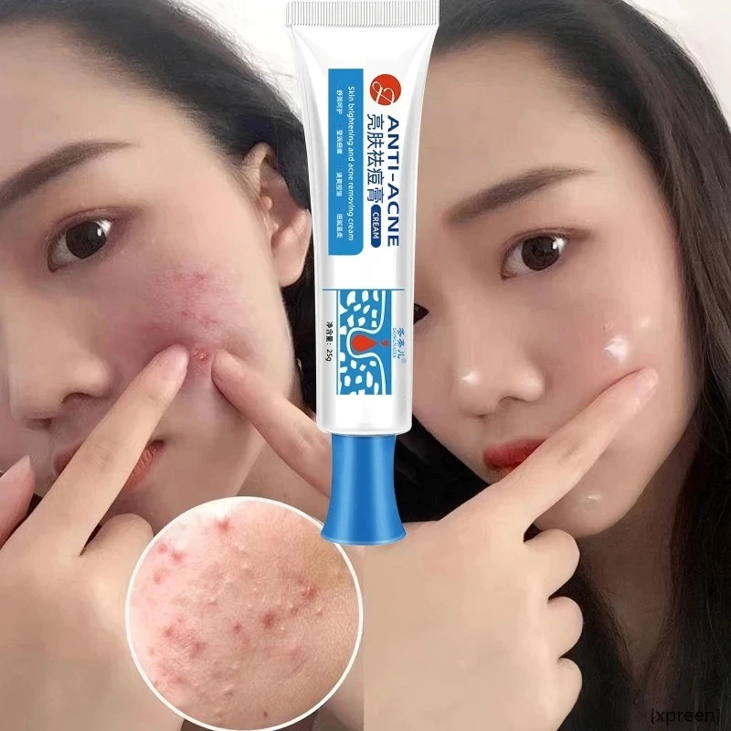 Dưỡng Trắng Mặt Giảm Mụn thâm mụn Cho mụn trứng cá, mụn đầu đen, mụn đầu trắng, mụn ẩn Dưỡng trắng d