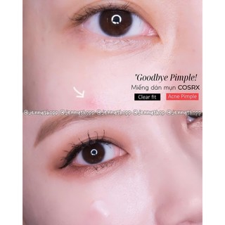 Miếng Dán Mụn Cosrx - Ciracle Red Spot Acne Pimple Patch
