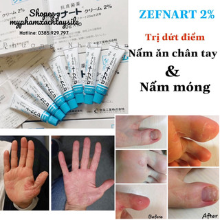 Kem Nấm Móng ZEFNART 2% - Kem Bôi Nước Ăn Chân Tay Nhật Bản