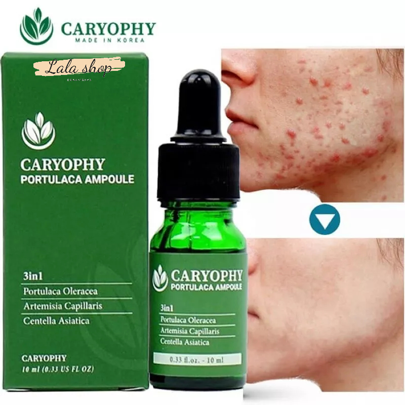 Serum rau má ngăn ngừa mụn và thâm Caryophy Mụn Ẩn,Mụn Đầu Đen
