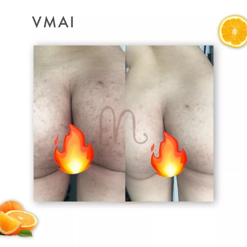 Soap Gluta-C đẩy lùi thâm mụn