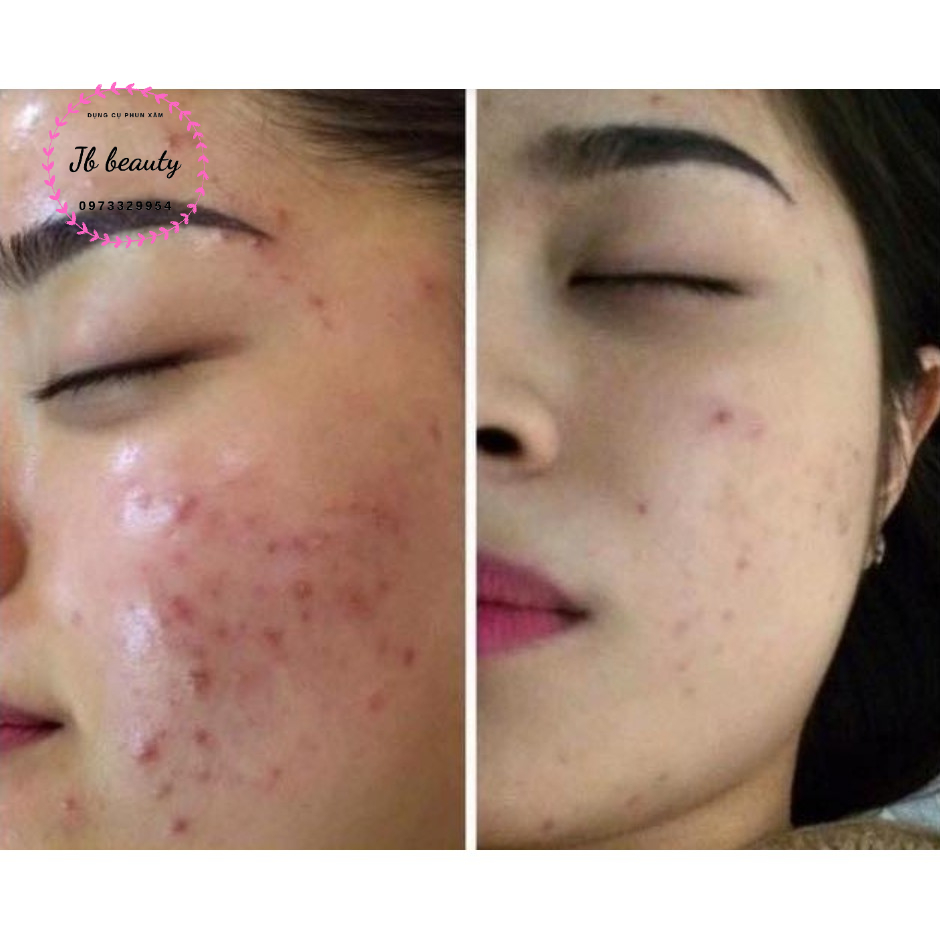 Kem Mụn Pure Skin Hàng Nội Địa Trung