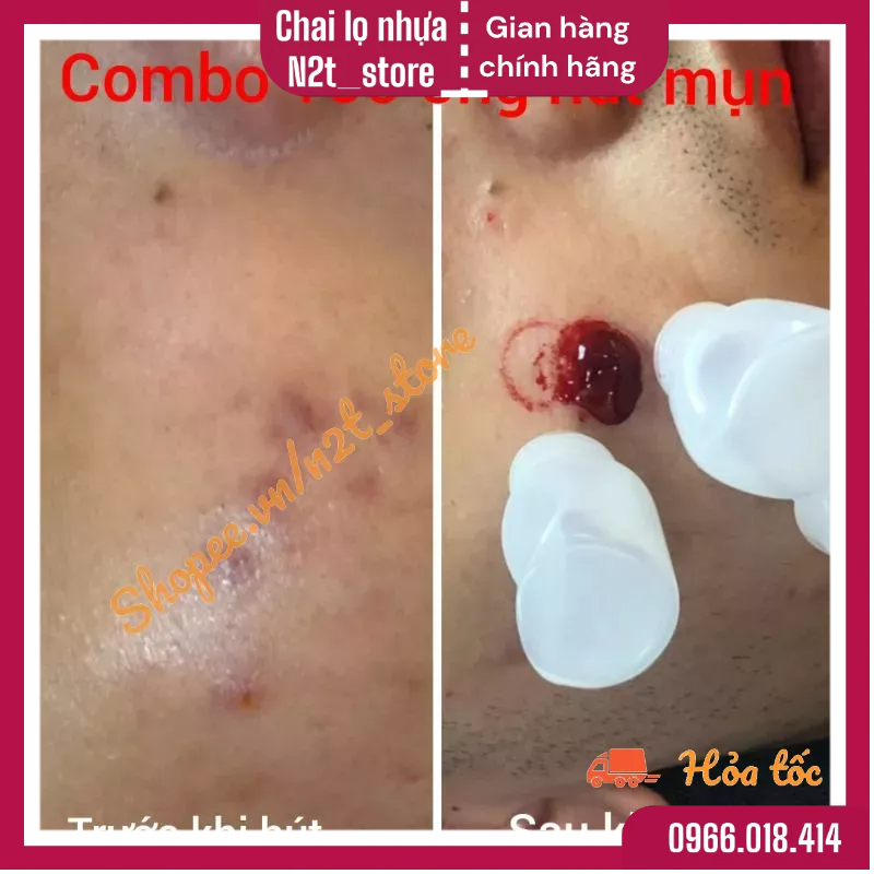 Ống hút máu mụn máu bầm siêu hút