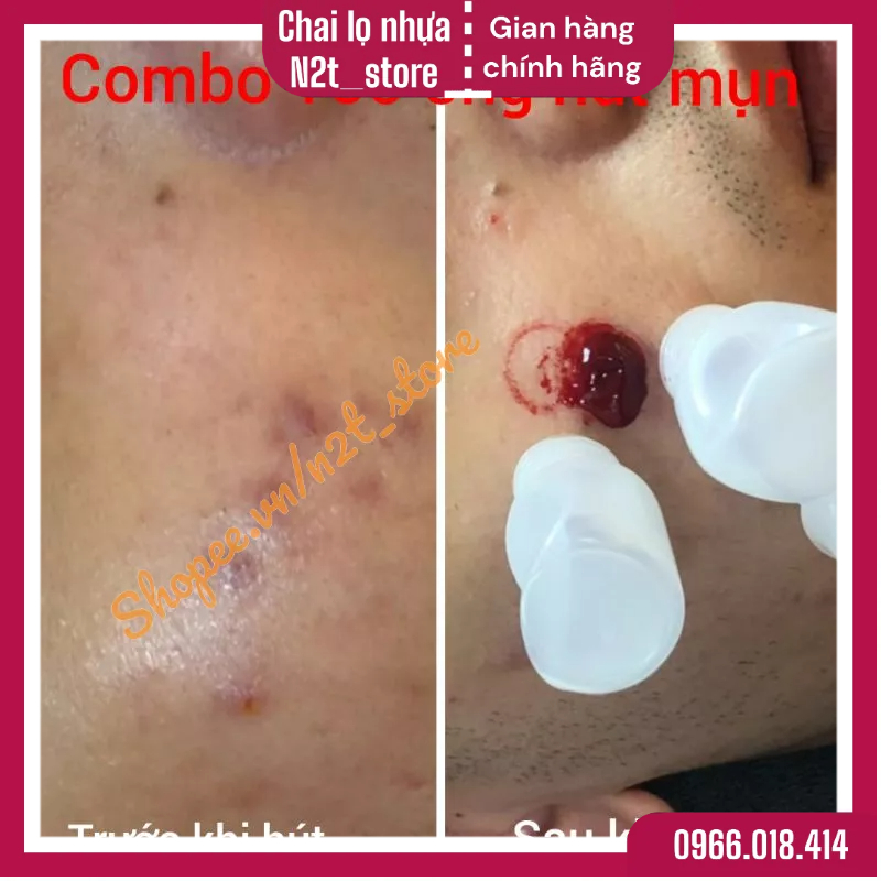 100 ống nhựa hút mụn viêm hút máu bầm