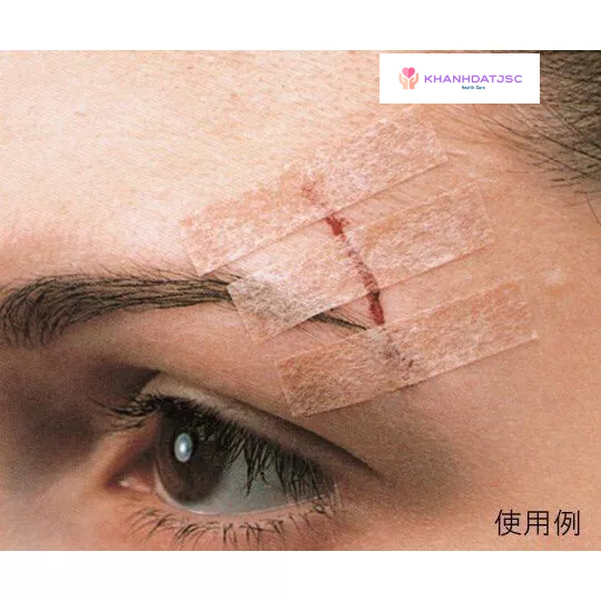 Băng y tế thay chỉ khâu da 3M STERI – STRIP B1557