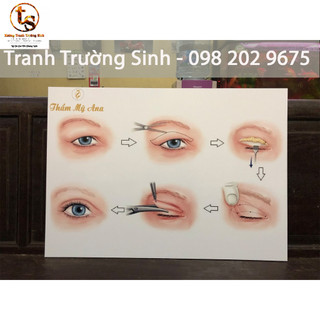TRANH PHẪU THUẬT CẮT MÍ (Miễn phí thiết kế và chèn tên logo)